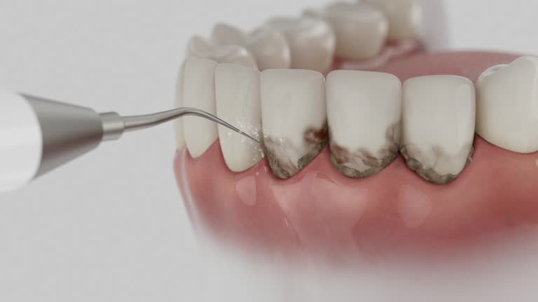 Reliable Tooth Extraction contractor in Mansfield, OH by Smile Center Dentistry